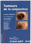 Tumeurs de la conjonctive vignette